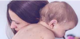 *المغرب يعلن تحول الحصبة إلى وباء و١٢٠ حالة وفاة*