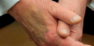 ما سبب الكدمات على يد ترامب