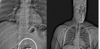 *لص يبتلع أقراطًا ماسية بقيمة 770 ألف دولار في سرقة مثيرة*