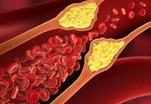 علامات تنذر بارتفاع مستويات الكوليسترول في الدم