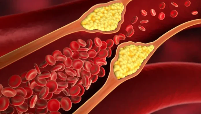Are_There_Symptoms_of_High_Cholesterol_142926_large
