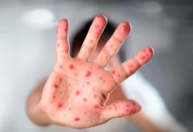 التفتيش المركزي يفتح تحقيقًا حول انتشار الحمى القلاعية